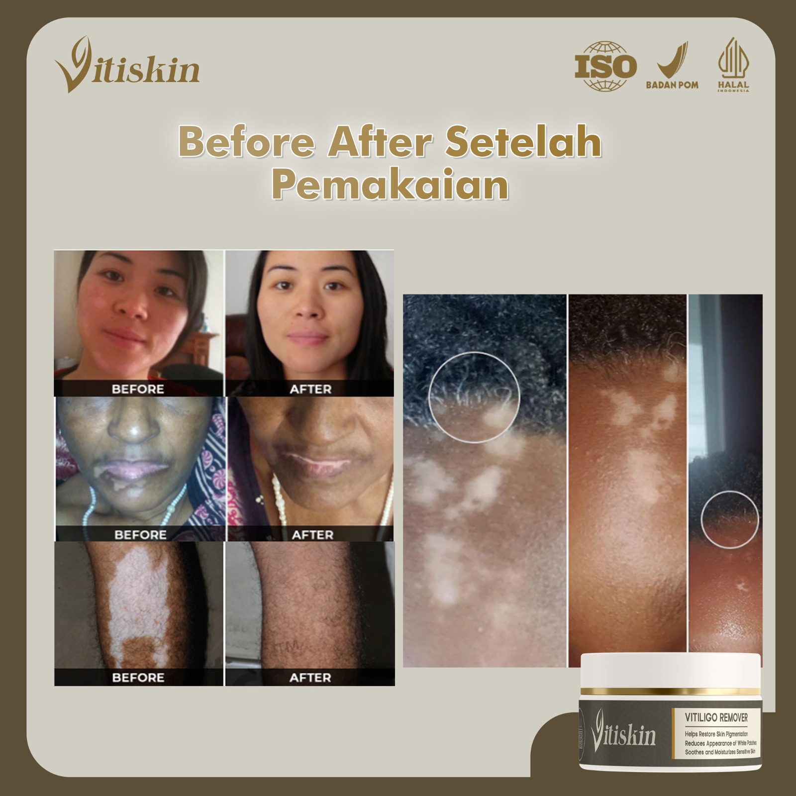 Salep Vitiskin Vitiligo Cream - Gambar 3