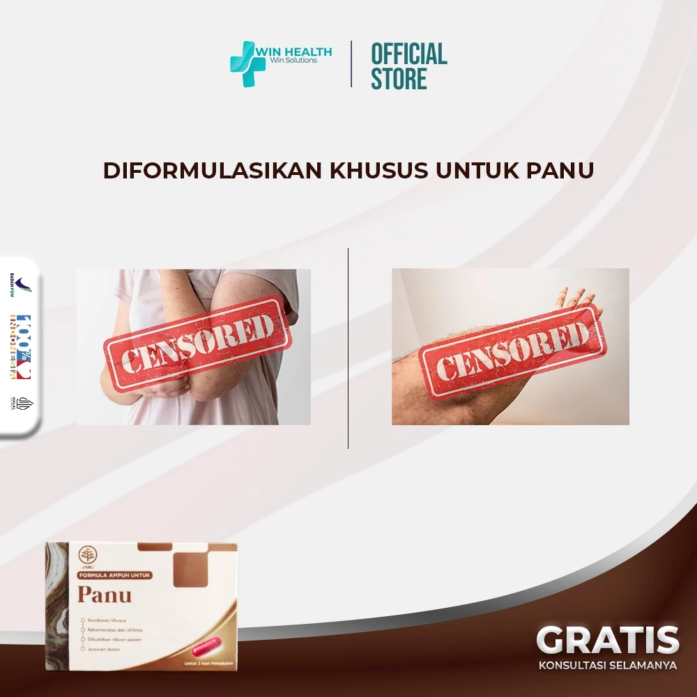 obat kurap alami, obat jamur dari dalam, obat panu megamedika, pengobatan panu modern, obat kulit herbal ampuh